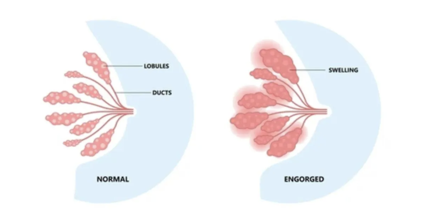 Breast Engorgement